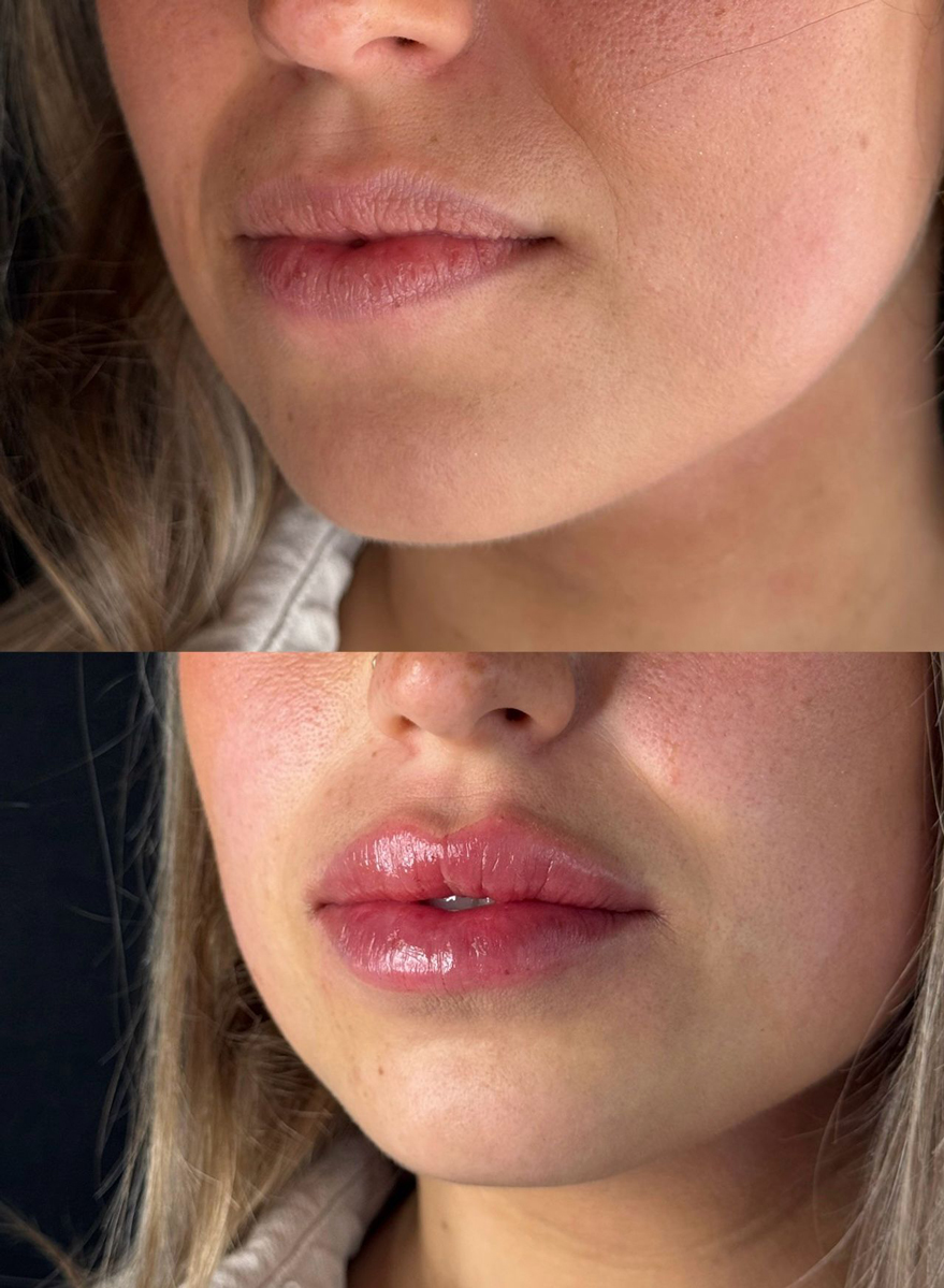 filler-labbra3