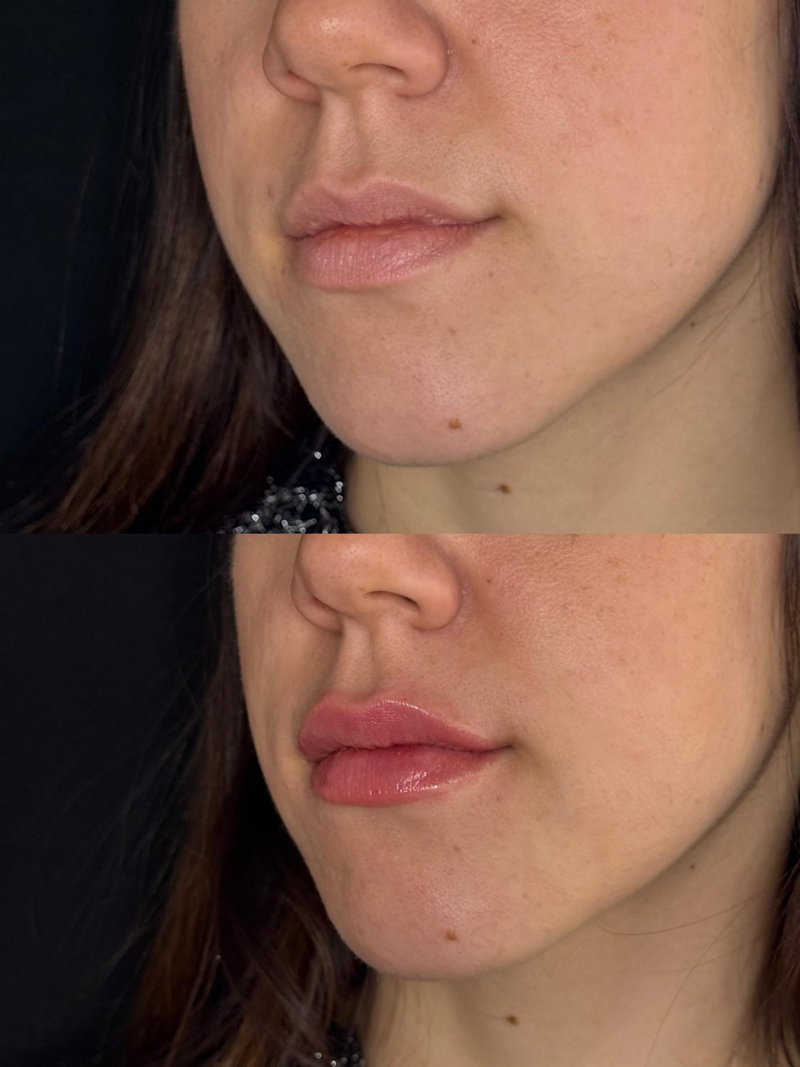 filler-labbra6