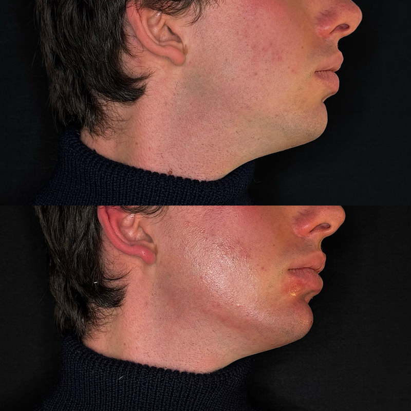 filler-viso1