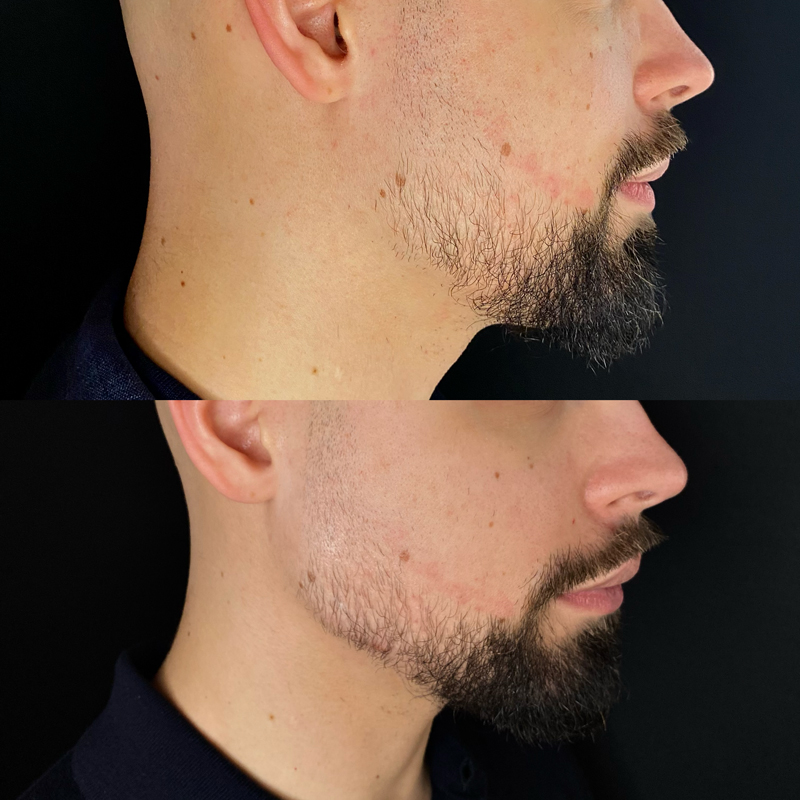 filler-viso4